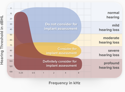 Audiogram — referral thresholds